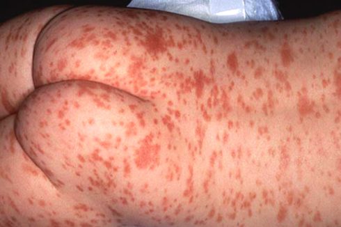 Terapias para la urticaria